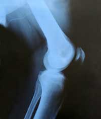 Osteoporosis